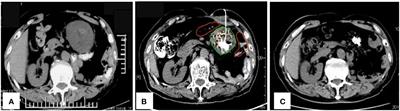 Case report: Highly response to low-dose brachytherapy in recurrent retroperitoneal leiomyosarcoma with FANCD2 frameshift mutation: a unique case study